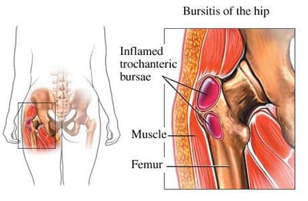 Hip pain bursitis diagram showing inflamed trochanteric bursae, muscle, and femur