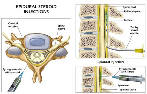 Lumbar epidural steroid injection diagram showing spinal cord, epidural space, catheter, and needle placement