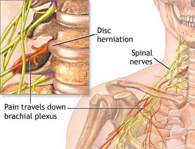 Cervical spine anatomy showing disc herniation, spinal nerves, and brachial plexus — neck pain treatment NYC