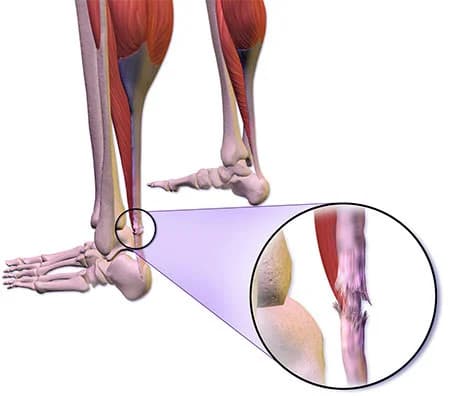 Achilles tendon tear treatment doctor ankle specialist NYC — Dr. Febin Melepura