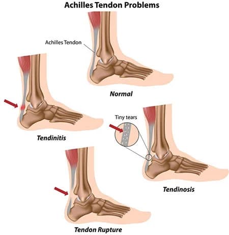 Ankle injuries treatment doctor specialist NYC — Dr. Febin Melepura