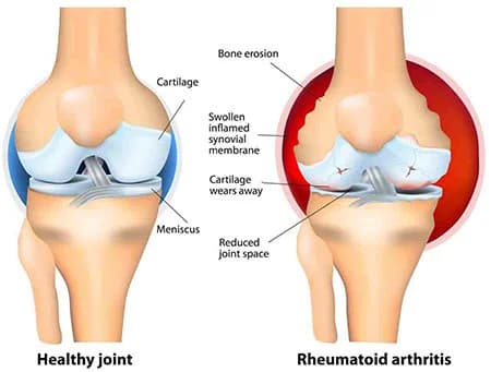 Knee arthritis treatment at Sports Pain Institute NYC — Dr. Febin Melepura