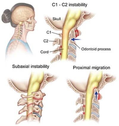 Neck arthritis treatment at Sports Pain Institute NYC — Dr. Febin Melepura