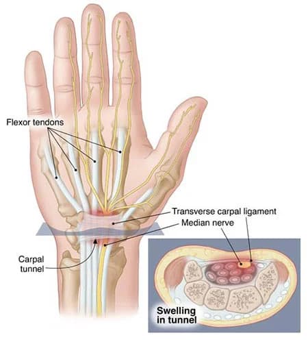 Carpal tunnel syndrome treatment doctor wrist specialist NYC — Dr. Febin Melepura