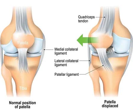 Chondromalacia patella treatment at Sports Pain Institute NYC — Dr. Febin Melepura