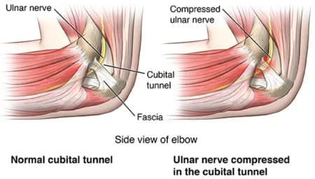 Cubital tunnel syndrome treatment doctor specialist NYC — Dr. Febin Melepura