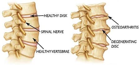 Neck degenerative disc disease treatment at Sports Pain Institute NYC — Dr. Febin Melepura