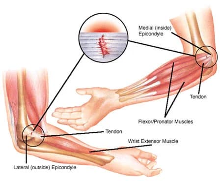 Elbow pain treatment at Sports Pain Institute NYC — Dr. Febin Melepura