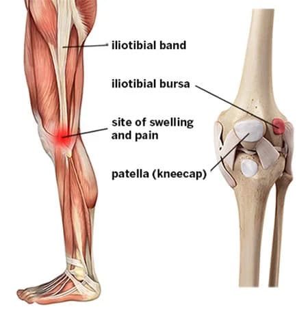 Iliotibial band syndrome treatment specialist NYC — SPIN Sports Pain Institute
