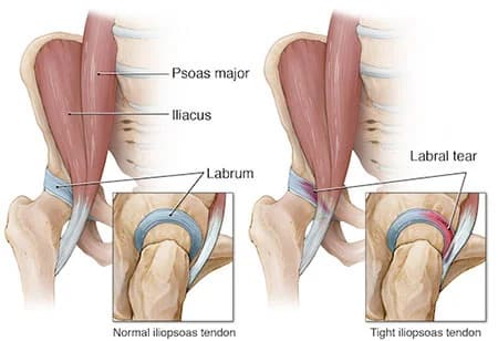 Hip labral tear treatment at Sports Pain Institute NYC — Dr. Febin Melepura