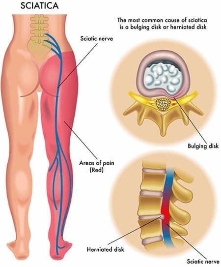 Sciatica and lower back pain diagram showing sciatic nerve, bulging disk, and herniated disk