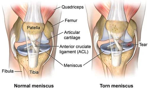 Meniscus tear treatment at Sports Pain Institute NYC — Dr. Febin Melepura