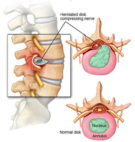 Middle back pain treatment doctor spine specialist NYC — Dr. Febin Melepura