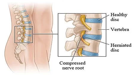 Back muscle spasm treatment doctor specialist NYC — Dr. Febin Melepura