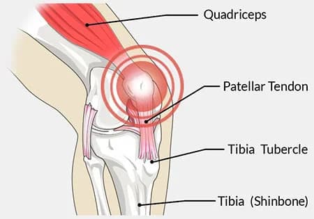 Patellar tendonitis treatment doctor knee specialist NYC — Dr. Febin Melepura