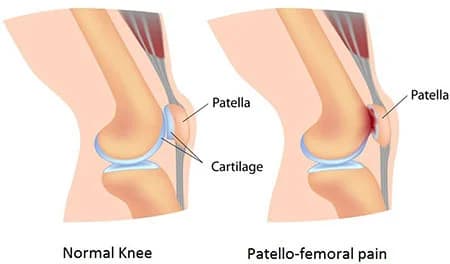 Patellofemoral pain syndrome treatment doctor specialist NYC — Dr. Febin Melepura