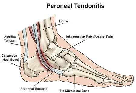 Peroneal tendonitis treatment at Sports Pain Institute NYC — Dr. Febin Melepura