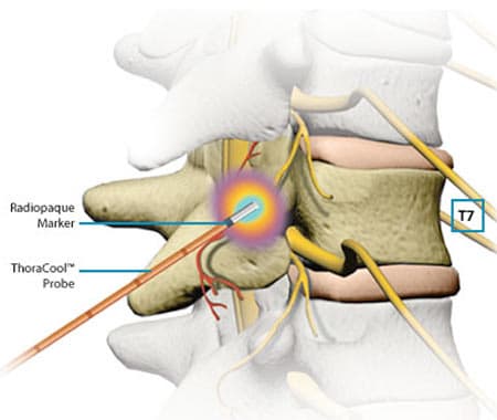 Radiofrequency ablation procedure illustration showing needle placement near spinal nerve