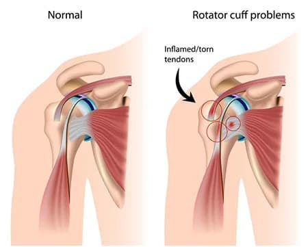 Rotator cuff injury treatment doctor specialist NYC — Dr. Febin Melepura