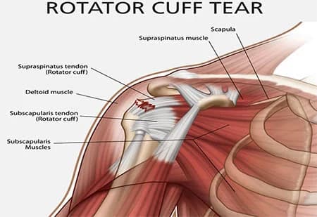 Rotator cuff tear treatment doctor shoulder specialist NYC — Dr. Febin Melepura