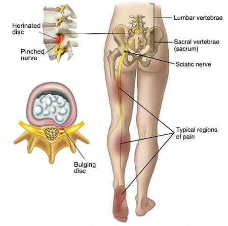 Sciatica nerve pain diagram showing sciatic nerve path from lower spine through the leg