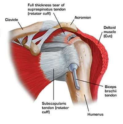 Shoulder injuries treatment doctor specialist NYC — Dr. Febin Melepura