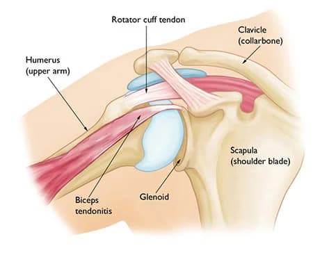 Shoulder sprain and strain treatment at Sports Pain Institute NYC — Dr. Febin Melepura