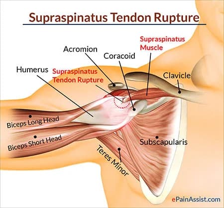 Shoulder tendonitis treatment doctor specialist NYC — Dr. Febin Melepura
