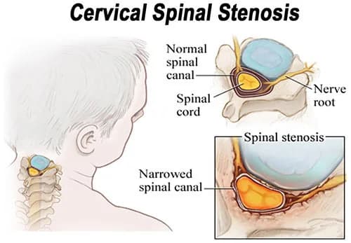 Stenosis of the neck treatment at Sports Pain Institute NYC — Dr. Febin Melepura