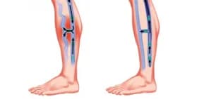 Vein treatment NYC — Dr. Febin Melepura leg vein specialist