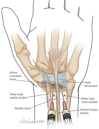 Wrist joint injection procedure at Sports Pain Institute NYC — Dr. Febin Melepura