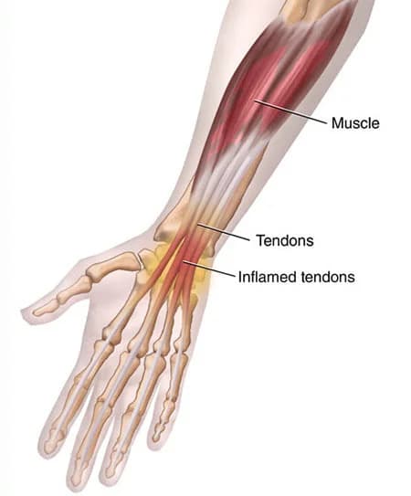 Wrist tendonitis treatment doctor specialist NYC — Dr. Febin Melepura