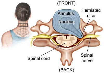Thoracic spine anatomy showing herniated disc, spinal cord, and spinal nerve — upper back pain treatment NYC