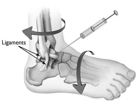 Ankle injection procedure at Sports Pain Institute NYC — Dr. Febin Melepura