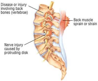 Back sprain treatment at Sports Pain Institute NYC — Dr. Febin Melepura