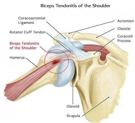 Bicep tendonitis treatment at Sports Pain Institute NYC — Dr. Febin Melepura