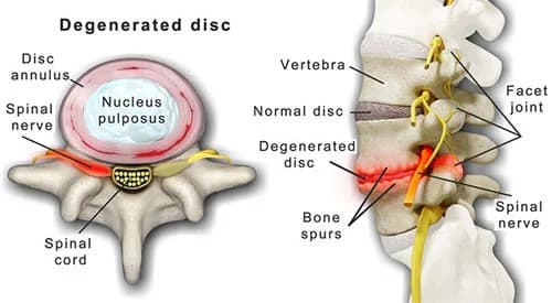 Degenerative disc disease treatment doctor back specialist NYC — Dr. Febin Melepura