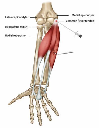 Elbow injection procedure at Sports Pain Institute NYC — Dr. Febin Melepura