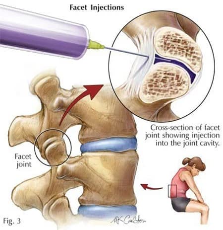 Facet joint syndrome treatment doctor spine specialist NYC — Dr. Febin Melepura