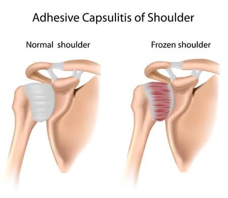 Frozen shoulder treatment doctor specialist NYC — Dr. Febin Melepura