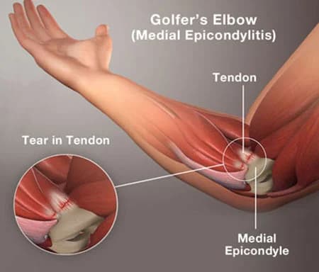 Golfer's elbow medial epicondylitis treatment doctor specialist NYC — Dr. Febin Melepura