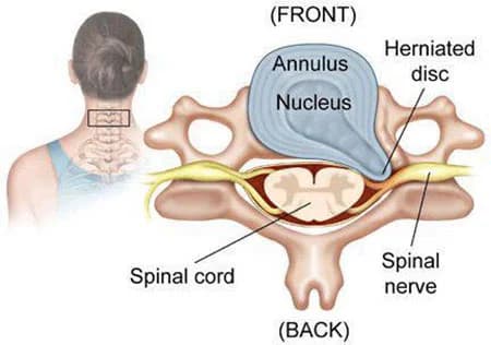 Herniated disc in the neck treatment at Sports Pain Institute NYC — Dr. Febin Melepura