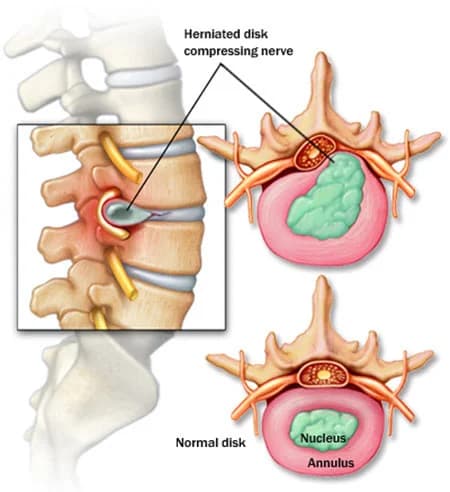Herniated discs treatment doctor specialist NYC — Dr. Febin Melepura