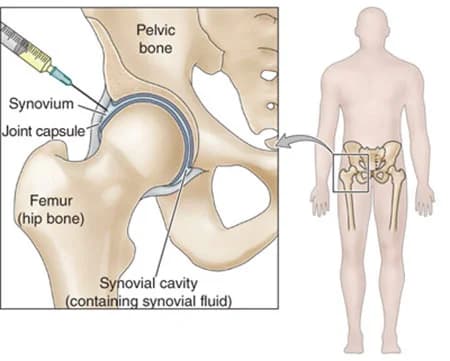 Hip joint injection procedure at Sports Pain Institute NYC — Dr. Febin Melepura