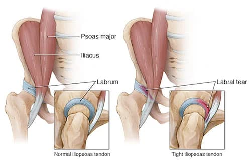 Hip tendonitis treatment doctor hip specialist NYC — Dr. Febin Melepura
