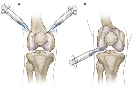 Knee injection procedure at Sports Pain Institute NYC — Dr. Febin Melepura
