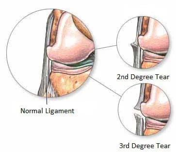 Knee ligament tear treatment doctor specialist NYC — Dr. Febin Melepura