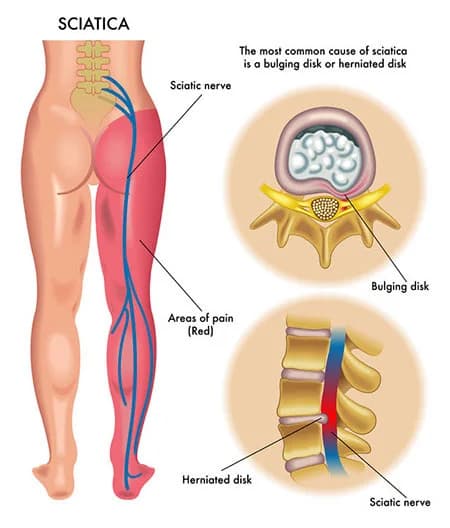 Lumbar radiculopathy treatment specialist NYC — SPIN Sports Pain Institute
