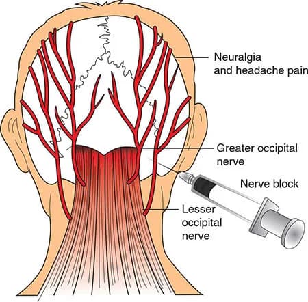 Occipital nerve block doctor specialist NYC — Dr. Febin Melepura