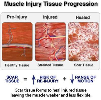 Pulled back muscle treatment at Sports Pain Institute NYC — Dr. Febin Melepura